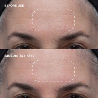 Wild Huckleberry 8-Acid Polishing Peel before and after